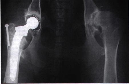Protéza kyčelního kloubu na RTG snímku