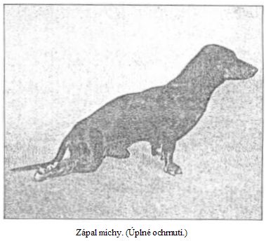 Zápal míchy. (Úplné ochrnutí.)